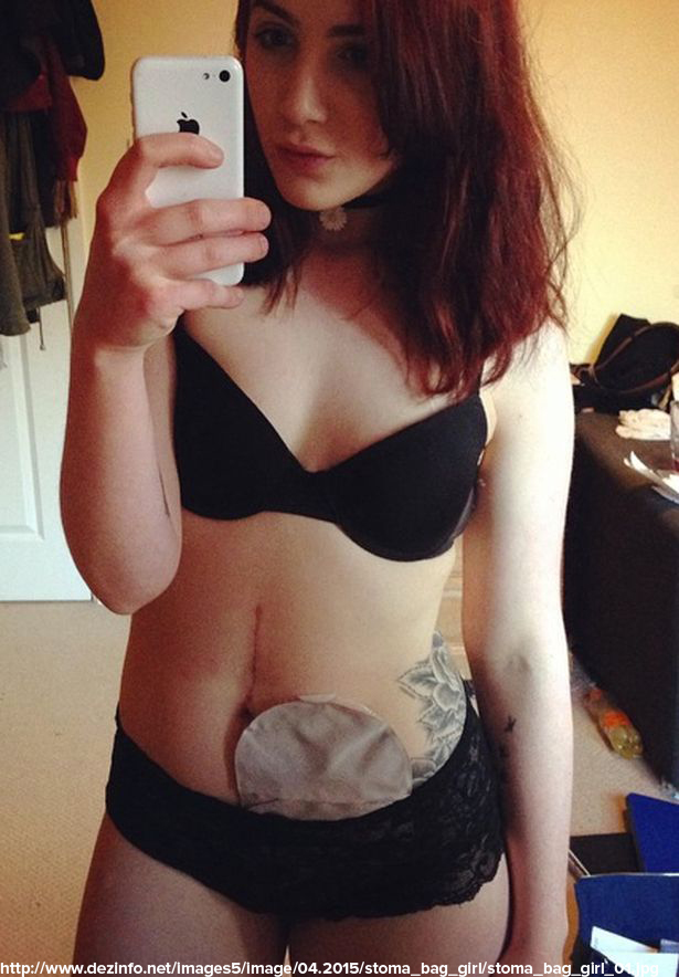 stoma_bag_girl_01.jpg